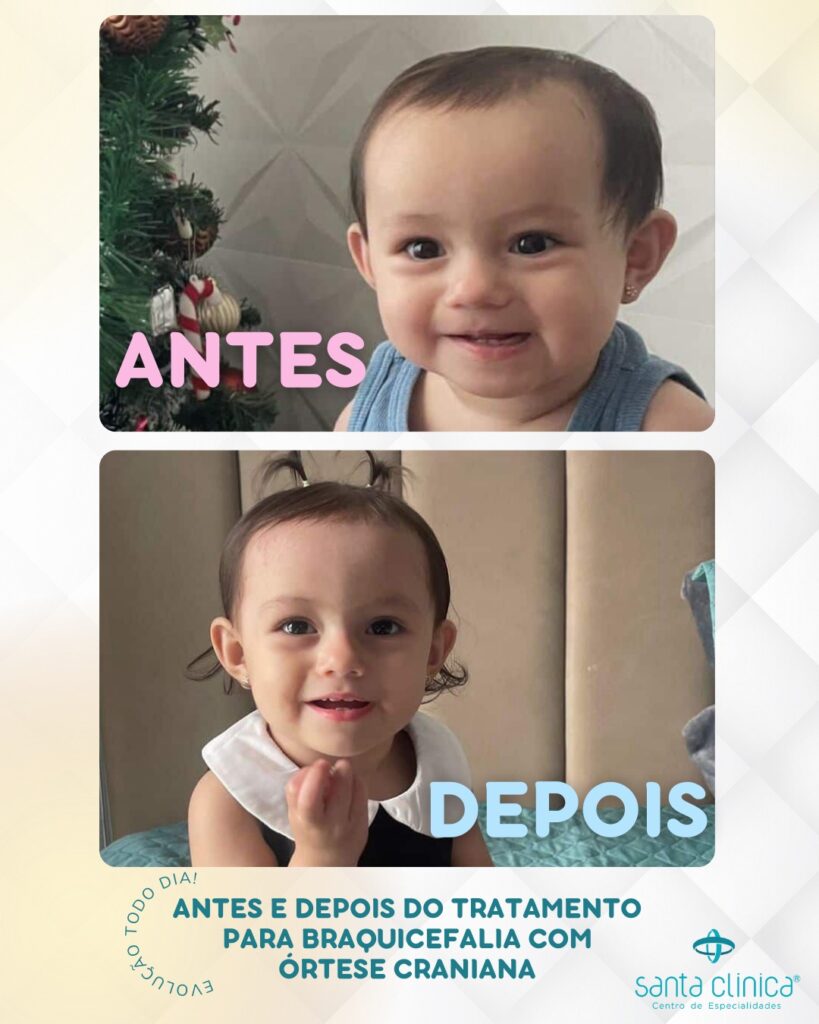 Tratamento da Braquicefalia com Órtese Craniana: o antes e depois que ...